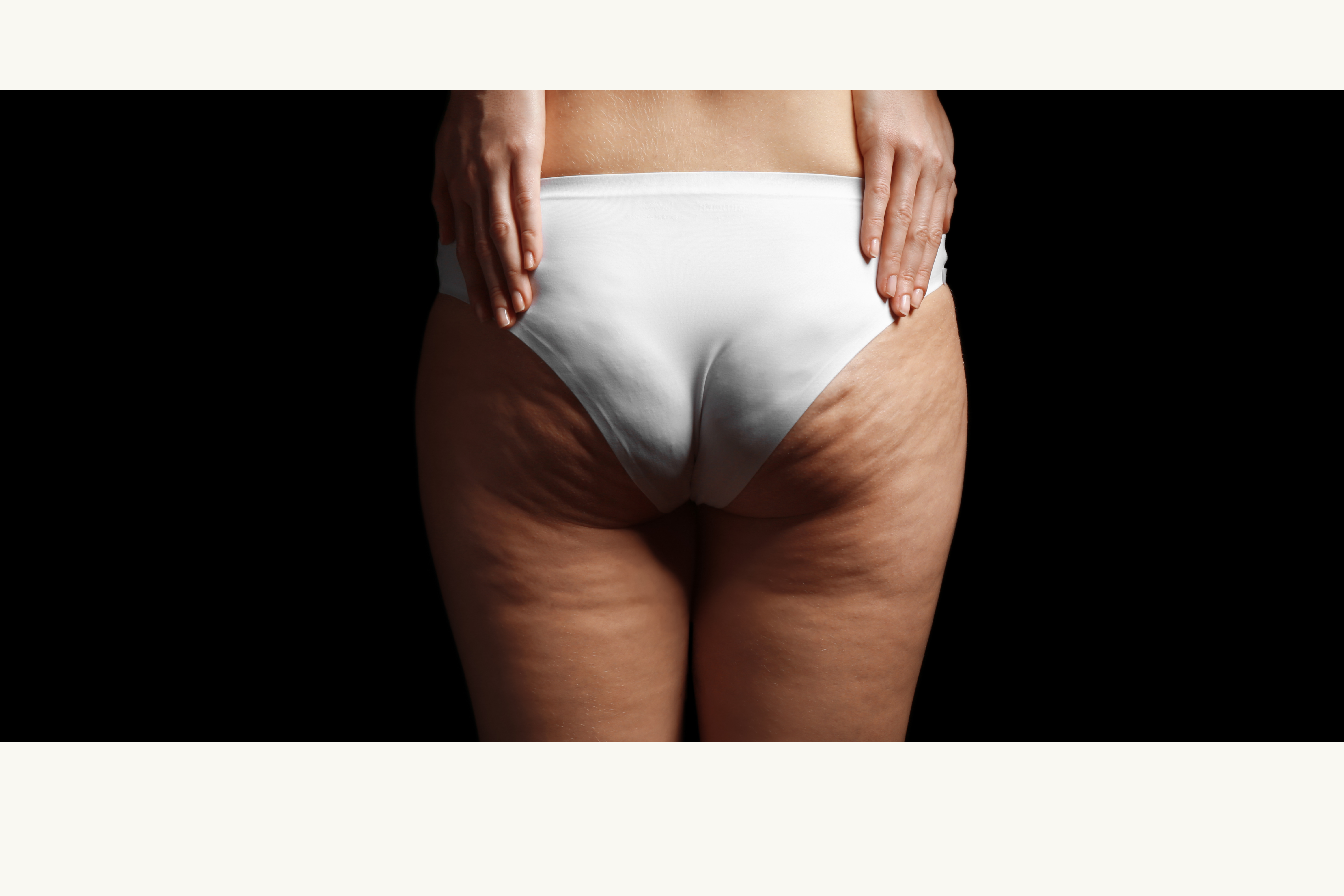 woman with cellulite