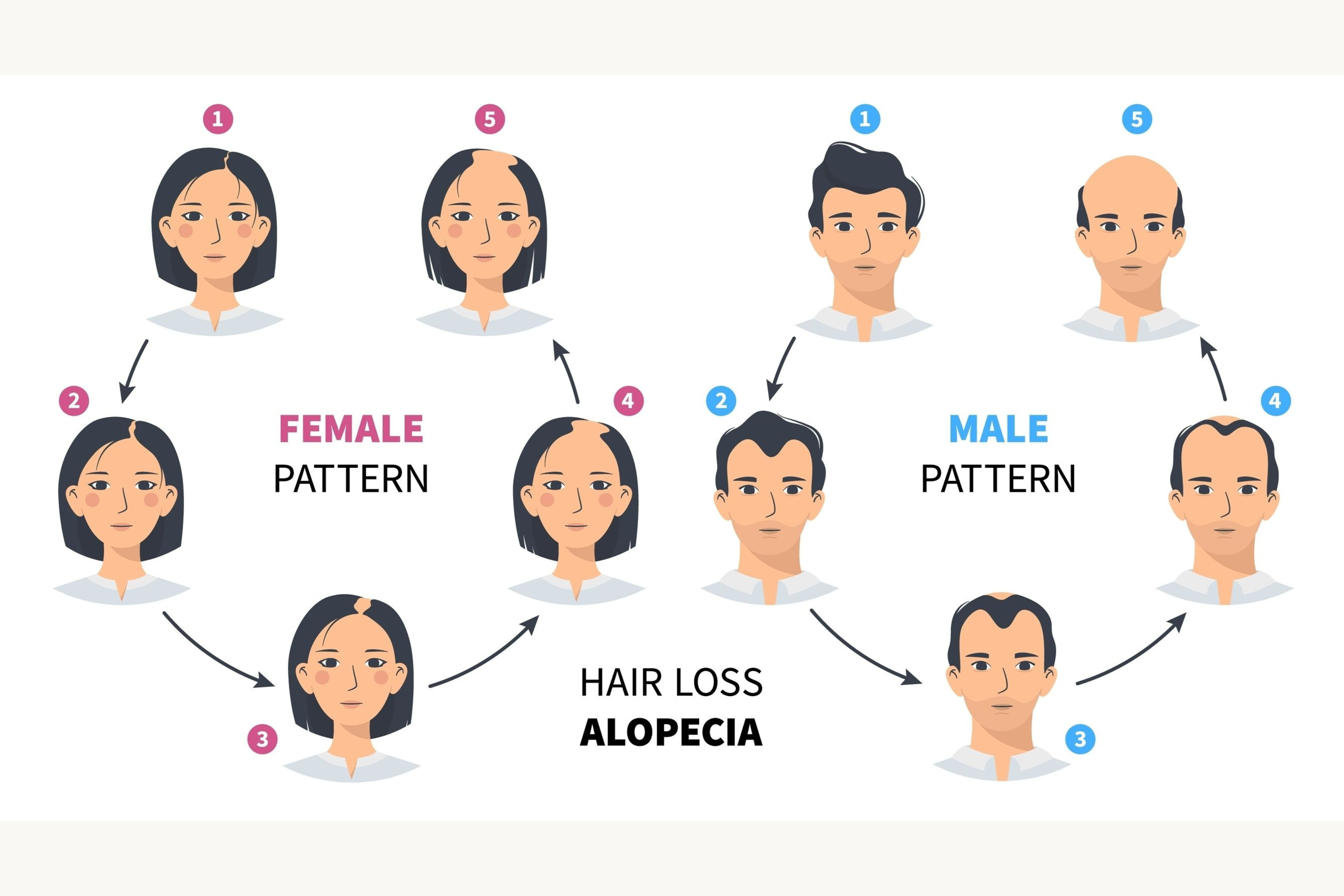 female and male patterns of alopecia