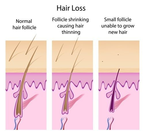 hair loss follicle and stages